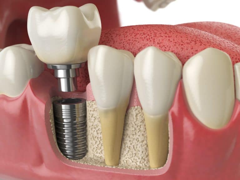 Anatomy of healthy teeth and tooth dental implants